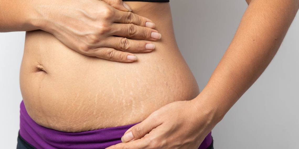 stretch-marks-after-weight-loss-causes-preventatives-healthifyme